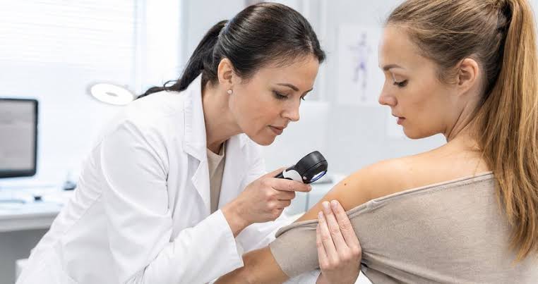 melanoma